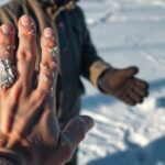Frostbite
